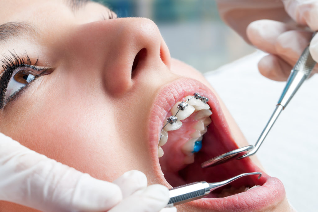 Orthodontics Services In Townsville Braces Dental Precinct